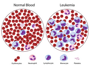 normalvleukemia